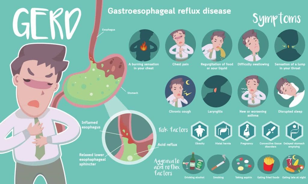 FAQs About Managing Gastroesophageal Reflux Disease