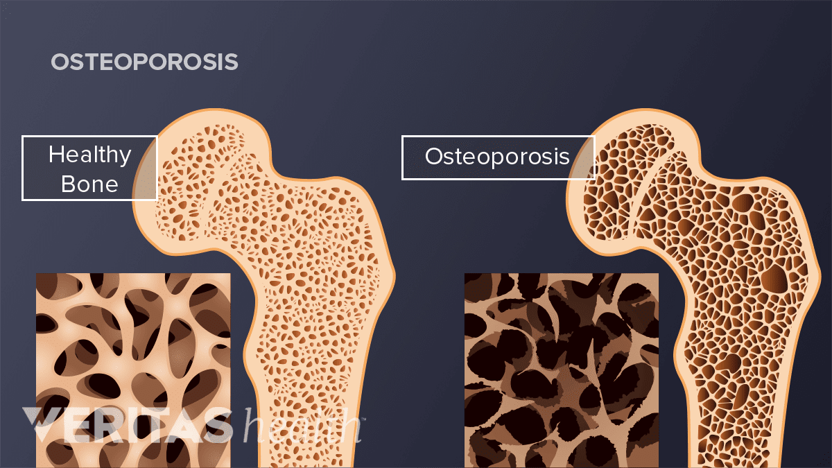 How To Lower Your Risk Of Developing Osteoporosis