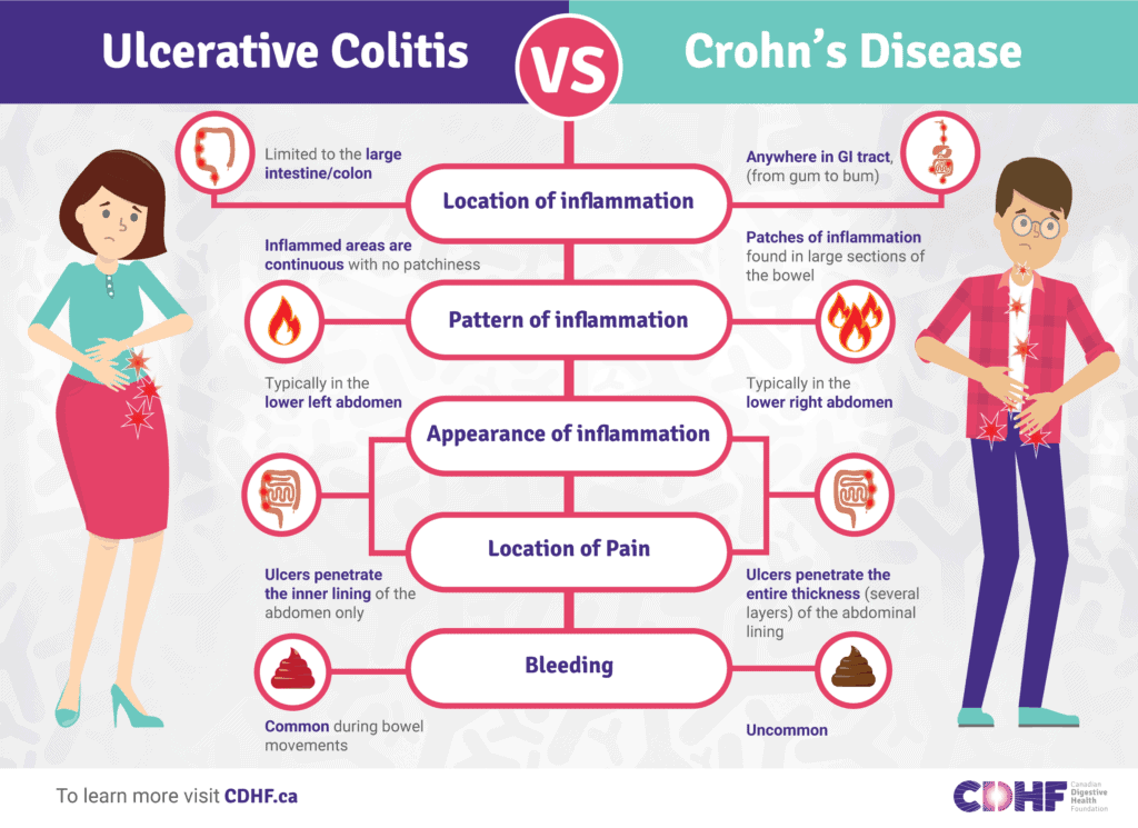 Understanding And Managing Crohns Disease: Treatment Options And Coping Strategies
