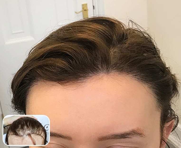 Essential Tips For Dealing With Female Hair Loss