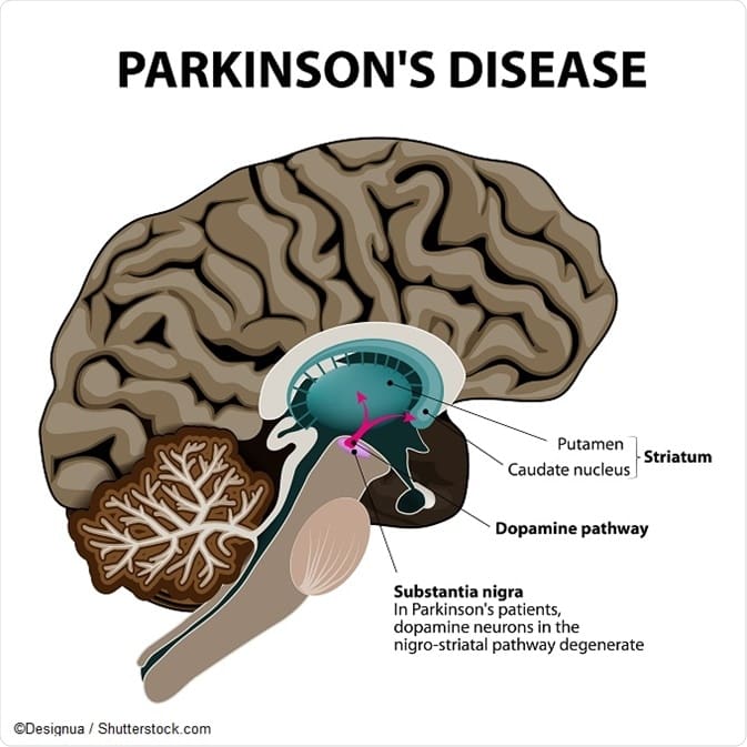 Improving Quality Of Life With Parkinson’s Disease: Practical Tips