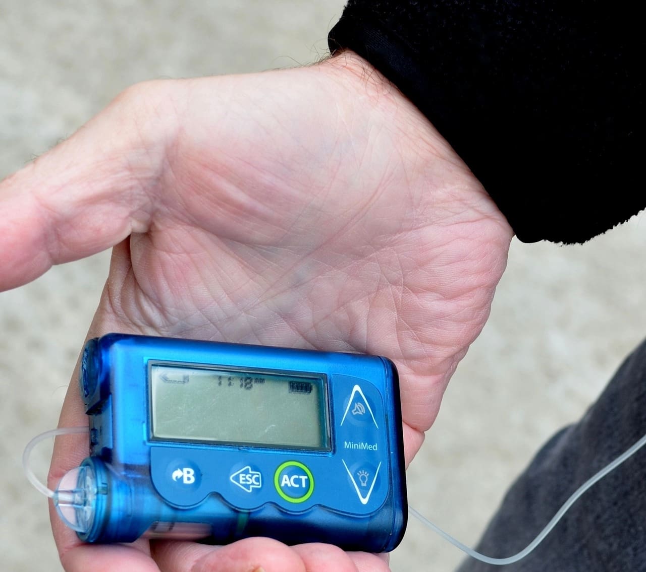 Buyer’s Guide For Insulin Pumps For Diabetes Management