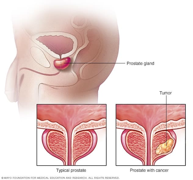 Common Prostate Health Issues In Men