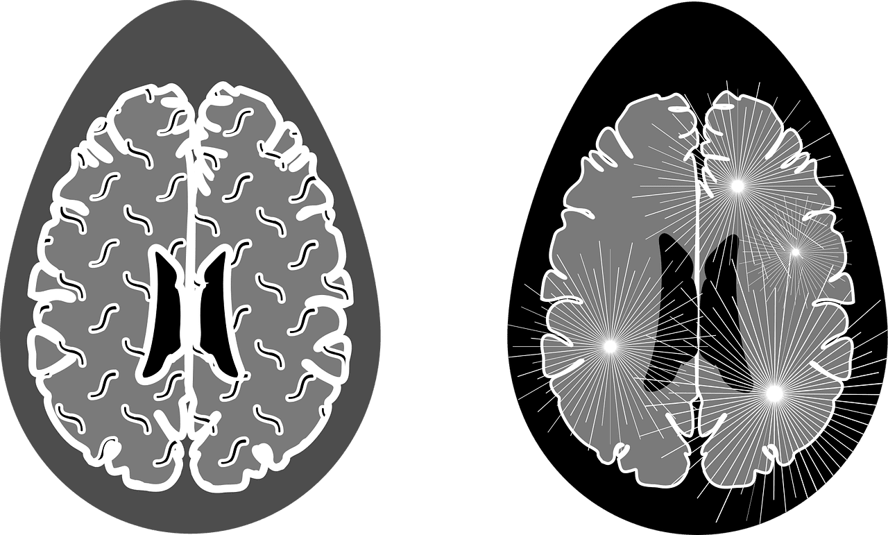 How To Prevent And Manage Multiple Sclerosis
