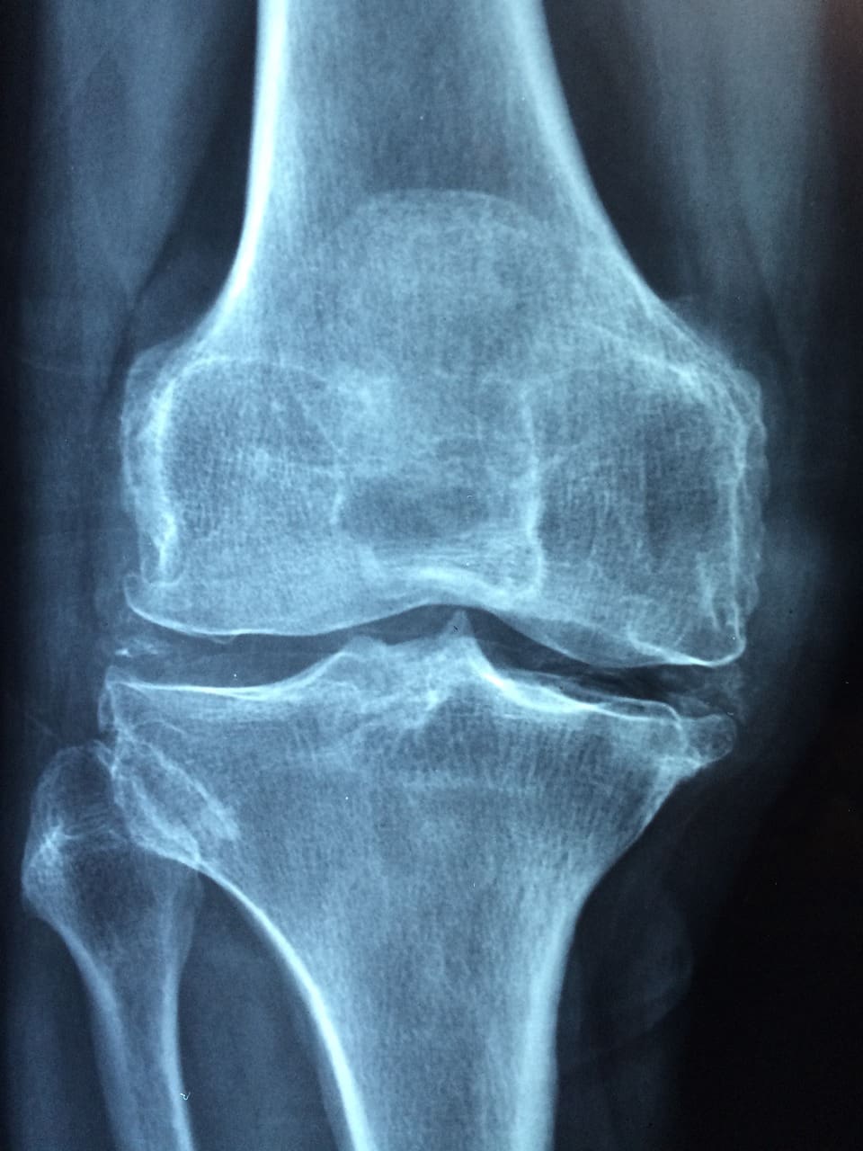 Top Ways To Control Symptoms Of Rheumatoid Arthritis
