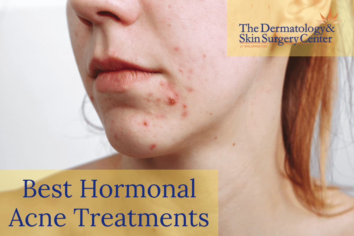 What Are The Best Practices For Hormonal Acne Treatment In Women?