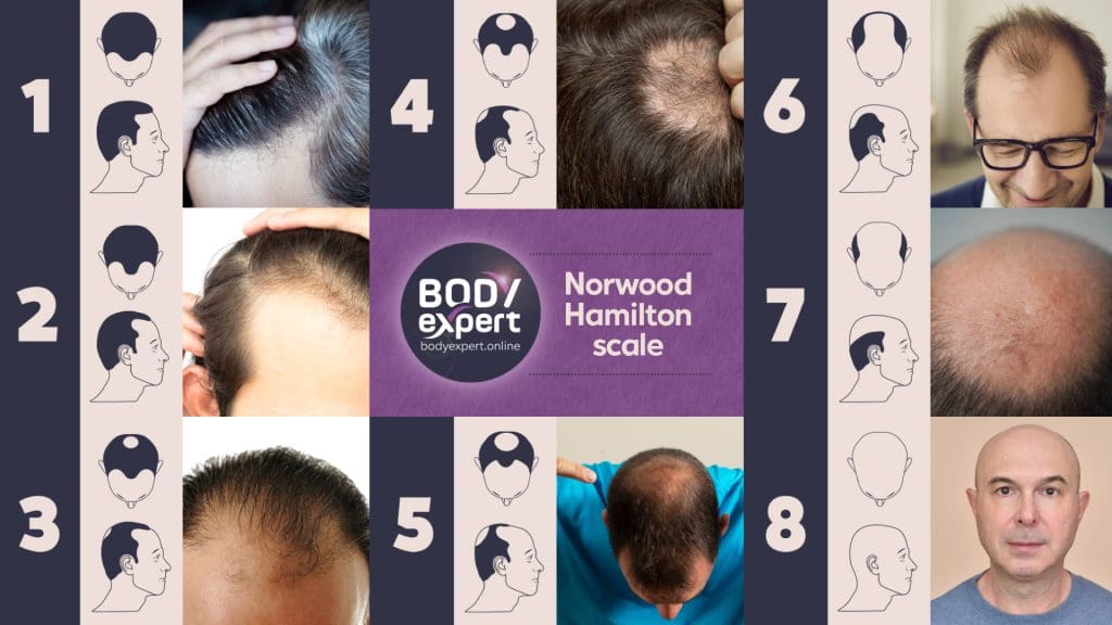 Understanding The Risks Of Male Pattern Baldness