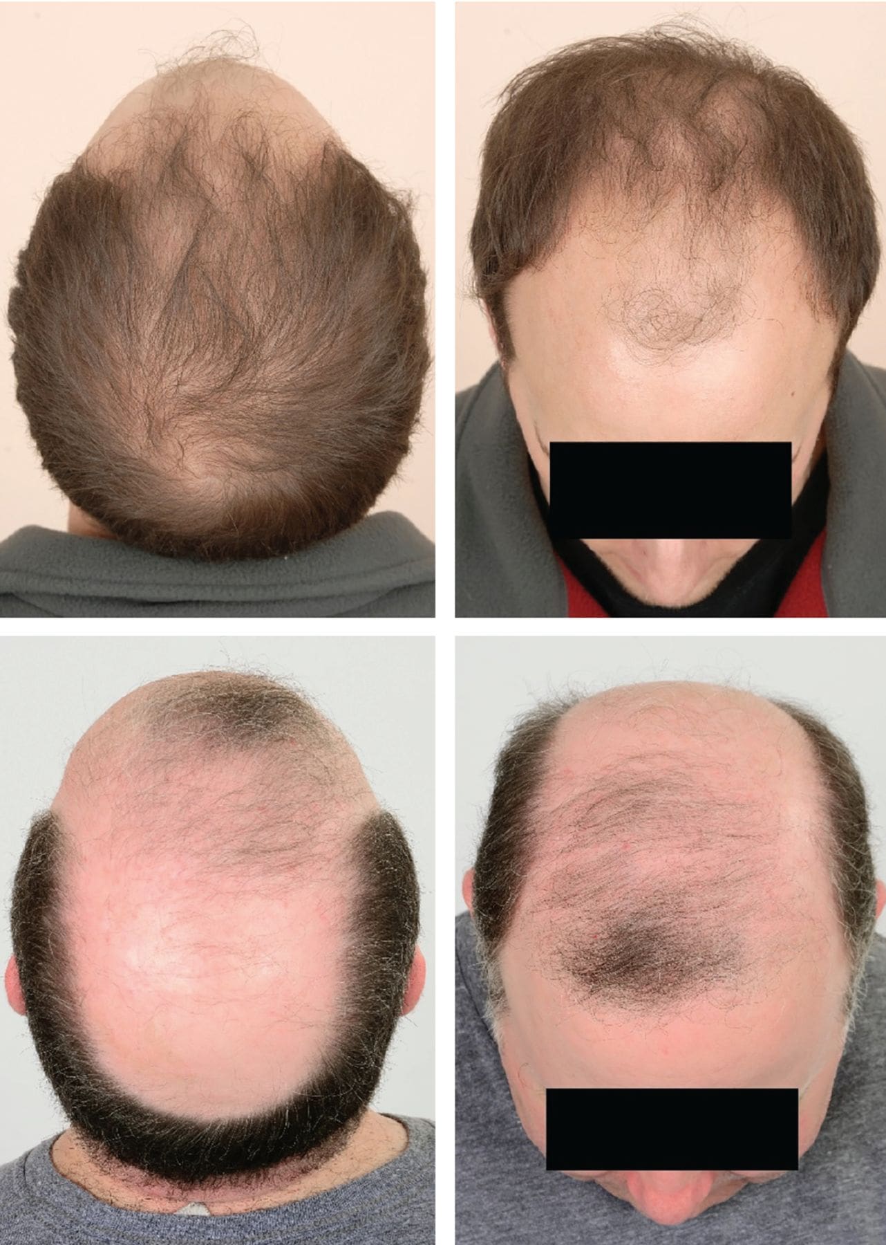 Understanding The Risks Of Male Pattern Baldness