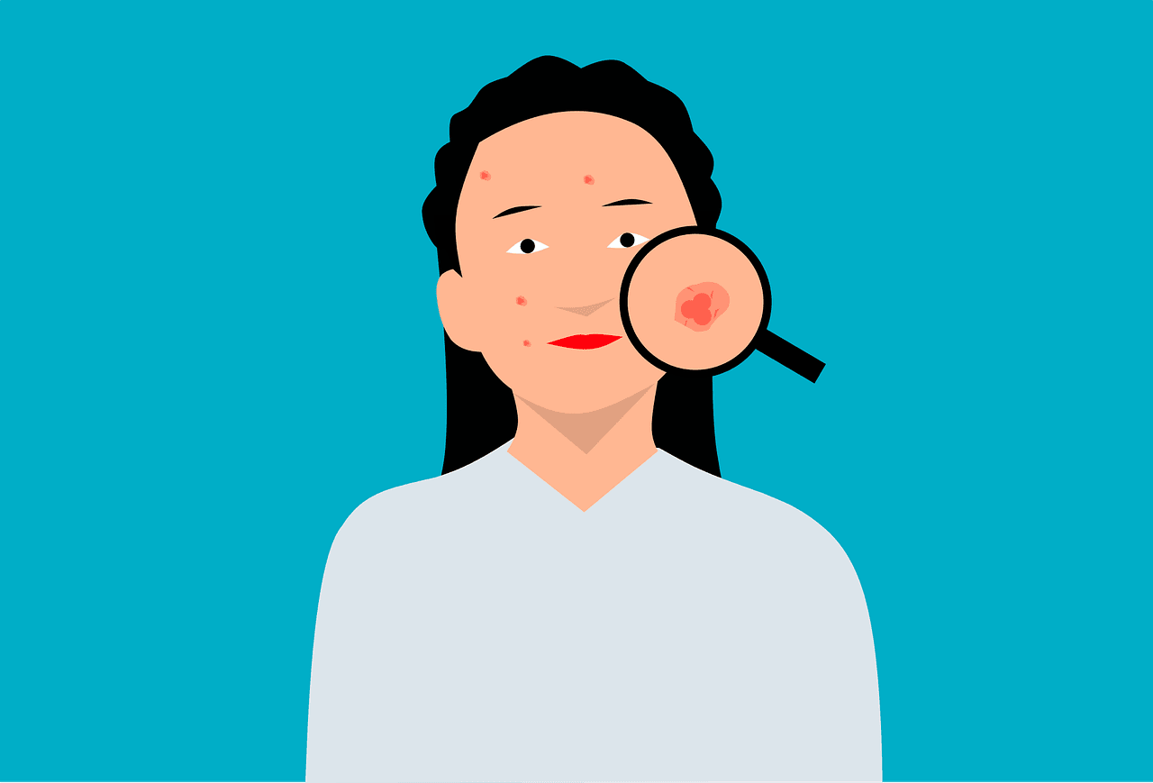 How To Manage Hormonal Acne Naturally