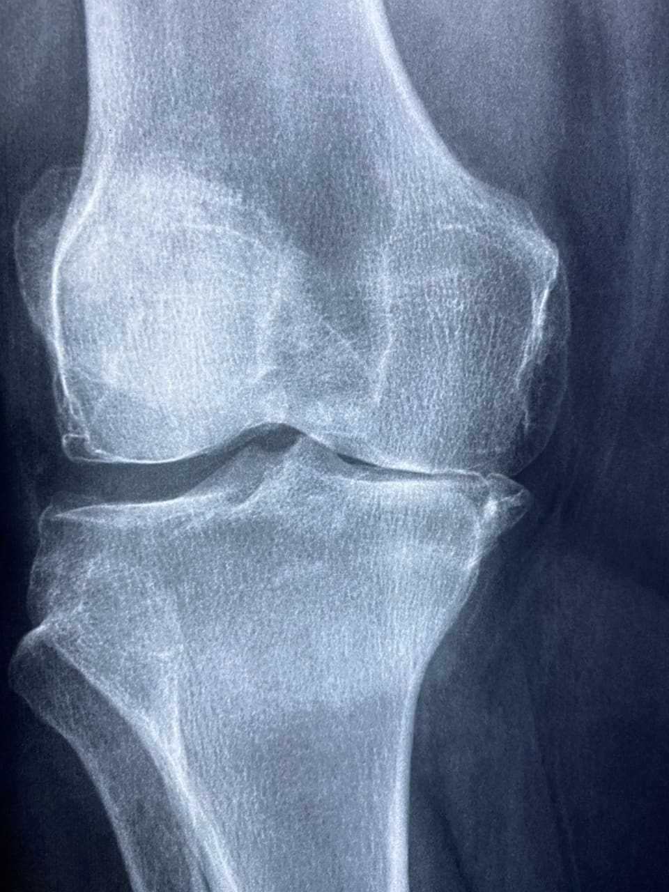 How To Manage Rheumatoid Arthritis Flares