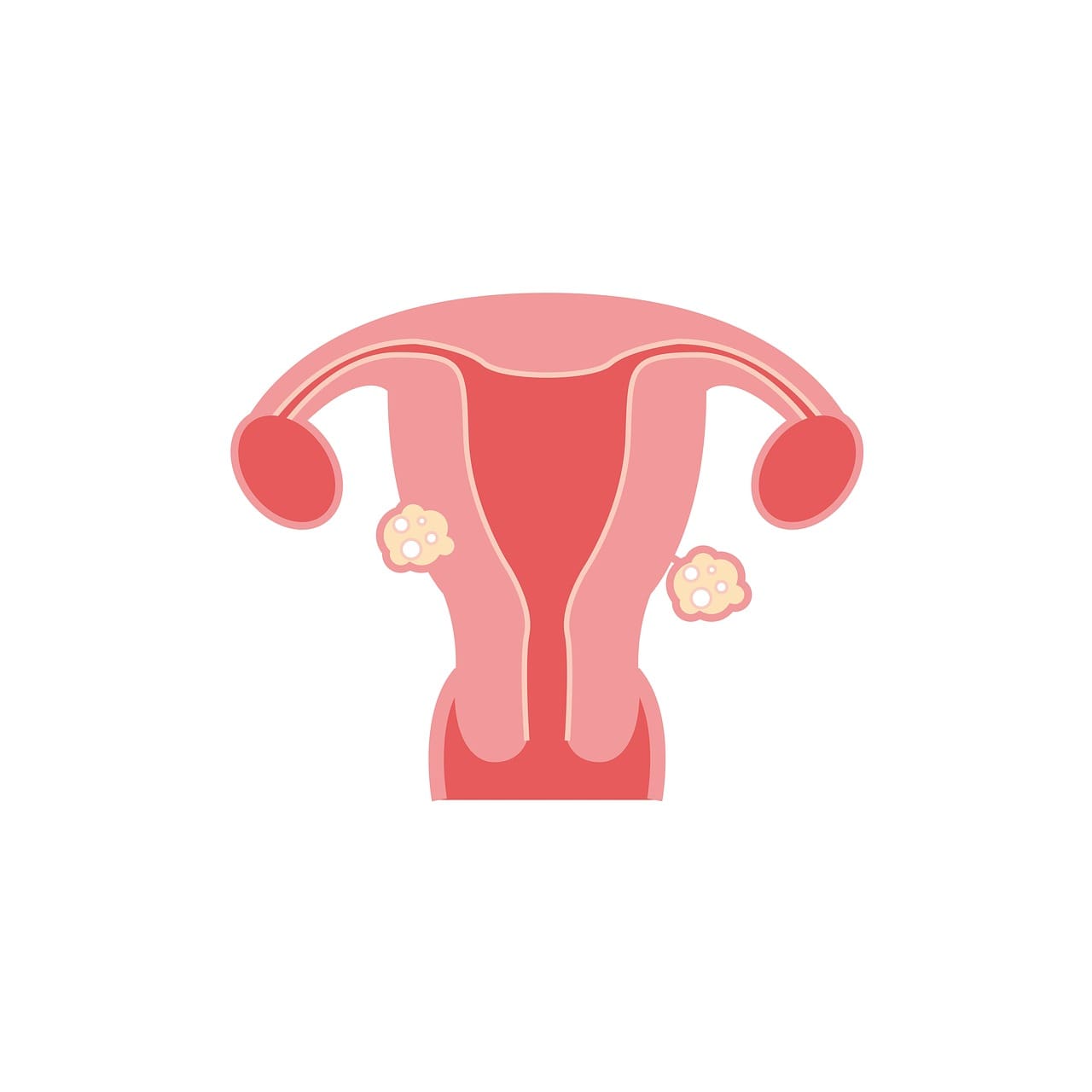 Top 10 Tips For Managing Fibroids Naturally Top 10 Tips For Managing Fibroids Naturally
